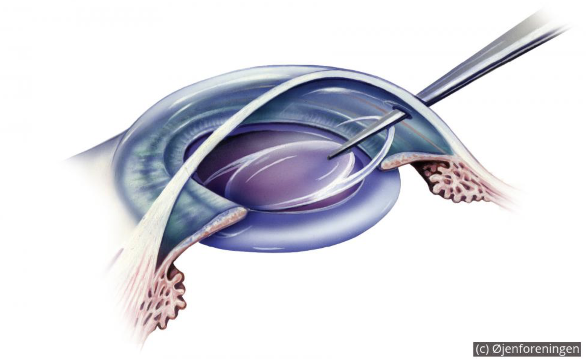 IOL implant illustration.png