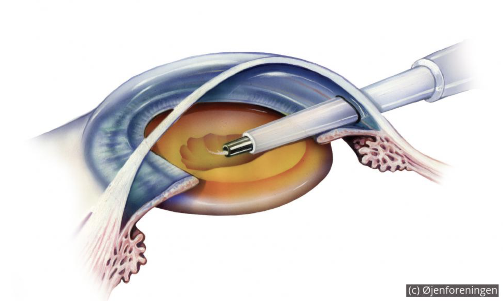 phaco illustration.png